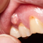 都筑区（都筑ふれあいの丘駅）の歯医者、マサキ歯科クリニックで、歯ぐきから膿が出る原因と放置した場合の影響や治療法を解説