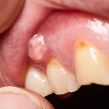 都筑区(都筑ふれあいの丘駅)の歯医者、マサキ歯科クリニックで、歯ぐきから膿が出る原因と放置した場合の影響や治療法を解説