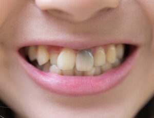 都筑区（都筑ふれあいの丘駅）の歯医者、マサキ歯科クリニックで、ホワイトニングしても歯が白くならない原因を解説