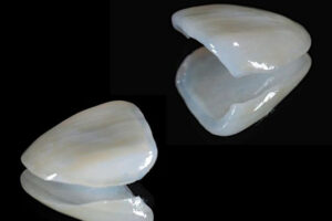 都筑区（都筑ふれあいの丘駅）の歯医者、マサキ歯科クリニックで、ホワイトニングしても歯が白くならない原因を解説