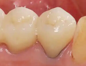 都筑区（都筑ふれあいの丘駅）の歯医者、マサキ歯科クリニックで、ホワイトニングしても歯が白くならない原因を解説