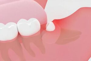 歯ぐきから膿が出る原因と放置した場合の影響や治療法