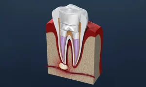 歯ぐきから膿が出る原因と放置した場合の影響や治療法