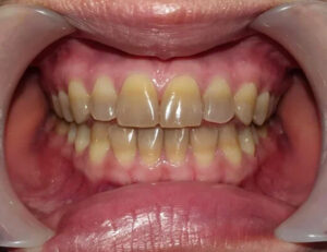 都筑区（都筑ふれあいの丘駅）の歯医者、マサキ歯科クリニックで、ホワイトニングしても歯が白くならない原因を解説