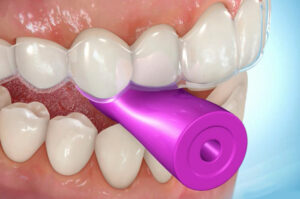 都筑区（都筑ふれあいの丘駅）の歯医者、マサキ歯科クリニックで、マウスピース矯正で話しにくい場合の対処法についての解説