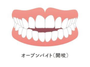 都筑区（都筑ふれあいの丘駅）の歯医者、マサキ歯科クリニックで、唇を噛む癖「咬唇癖」が引き起こす歯並びへの影響と対処法を解説