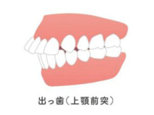 都筑区（都筑ふれあいの丘駅）の歯医者、マサキ歯科クリニックで、唇を噛む癖「咬唇癖」が引き起こす歯並びへの影響と対処法を解説