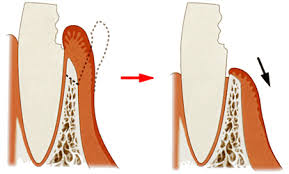 都筑区（都筑ふれあいの丘駅）の歯医者、マサキ歯科クリニックで、歯冠長延長術を解説
