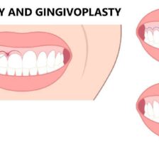 都筑区（都筑ふれあいの丘駅）の歯医者、マサキ歯科クリニックで、歯冠長延長術を解説