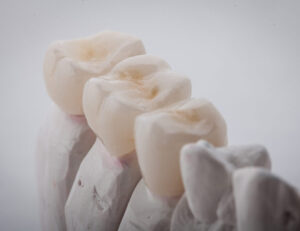 都筑区（都筑ふれあいの丘駅）の歯医者、マサキ歯科クリニックで、オールセラミックとジルコニアの違いは？審美性と強度の比較を解説