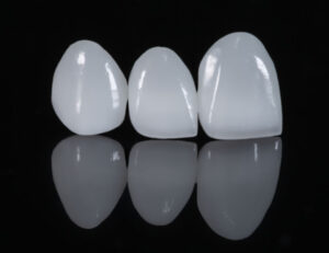 都筑区（都筑ふれあいの丘駅）の歯医者、マサキ歯科クリニックで、オールセラミックとジルコニアの違いは？審美性と強度の比較を解説