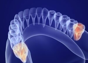 都筑区(都筑ふれあいの丘駅)の歯医者、マサキ歯科クリニックの親知らずが生える前兆についての解説