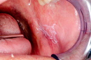 都筑区（都筑ふれあいの丘駅）の歯医者、マサキ歯科クリニックで、歯ぐきの皮がむける原因についての解説