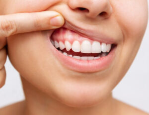 都筑区（都筑ふれあいの丘駅）の歯医者、マサキ歯科クリニックで、歯ぐきの皮がむける原因についての解説