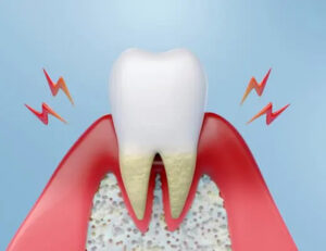 妊娠中の歯ぐき出血の原因とマタニティ期のオーラルケアを解説