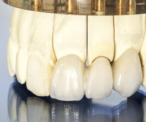 セラミック治療後の詰め物・かぶせ物を長持ちさせるセルフケアと注意点を解説