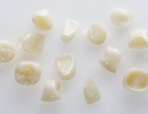 都筑区（都筑ふれあいの丘駅）の歯医者、マサキ歯科クリニックで、CAD/CAM冠の10年後の変色リスクと予防法を解説