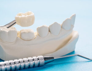 都筑区（都筑ふれあいの丘駅）の歯医者、マサキ歯科クリニックで、CAD/CAM冠の10年後の変色リスクと予防法を解説