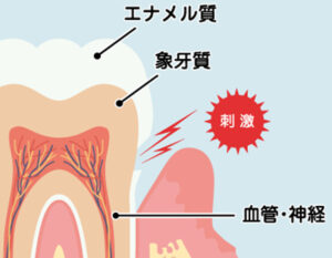 都筑区（都筑ふれあいの丘駅）の歯医者、マサキ歯科クリニックで、歯科におけるチッピングとは？原因や治療法、予防法を解説